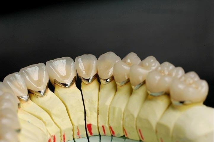 Couronne céramo-métallique CCM de haute durabilité à Marrakech - ELWAFA DENTAL