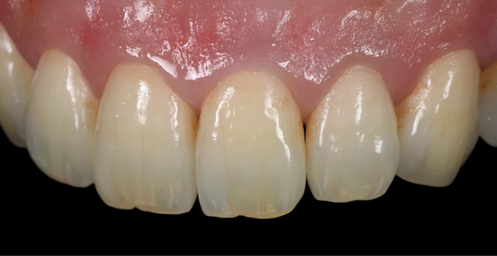 Céramique dentaire Emax stratifiée à la main à Marrakech - Laboratoire ELWAFA DENTAL