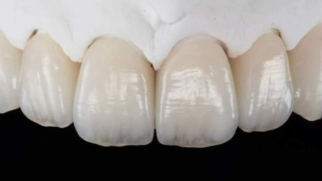Facette feldspathique artisanale de haute précision à Marrakech - Laboratoire ELWAFA DENTAL